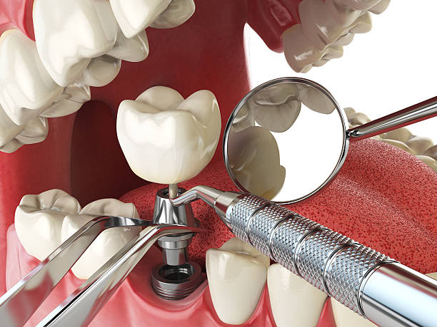 Best Lost Filling or Crown Replacement in East Washington, PA